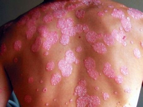Psoriatic