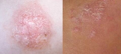 Psoriasis of the initial stage